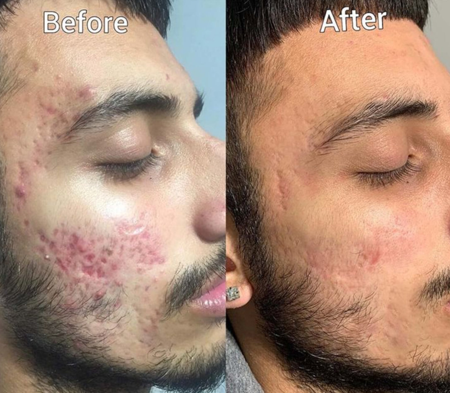 Clear Acne Serum PRO + Acne Soothing Moisturizer