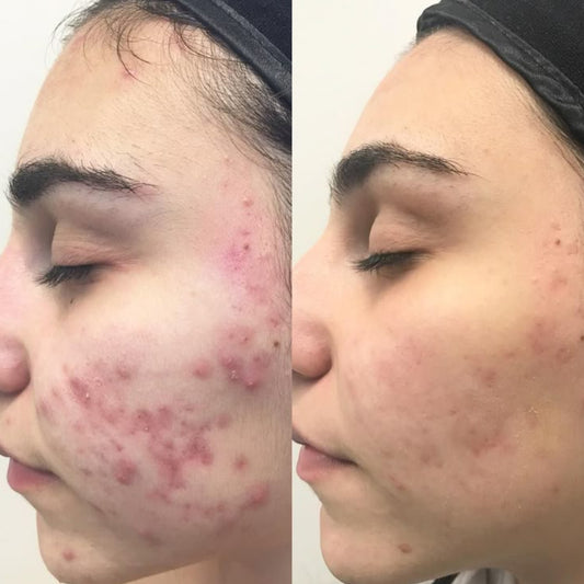 Clear Acne Serum 2% Salicylic Acid