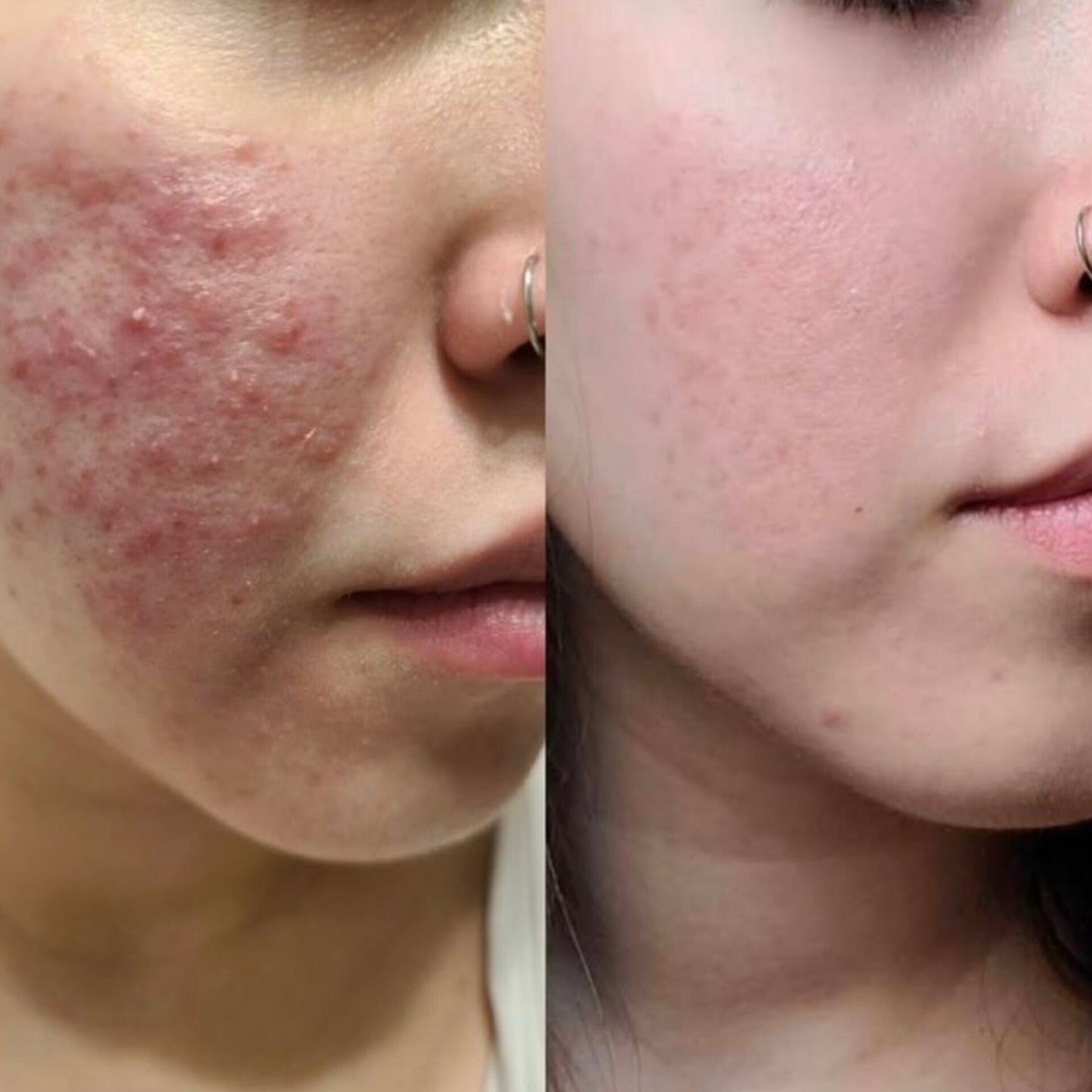 Clear Skin Combo – Acne Serum + Facewash (7 Days Acne Removal Guaranteed)