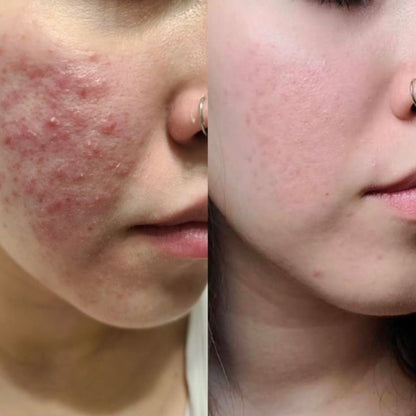 Clear Skin Combo – Acne Serum + Facewash (7 Days Acne Removal Guaranteed)