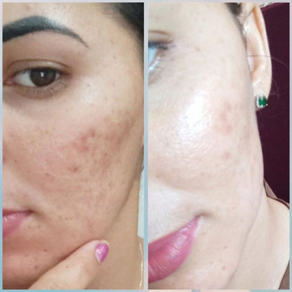 Clear Gel Face Wash with 2% Salicylic Acid + Glycolic Acid (For Acne-Prone Skin)