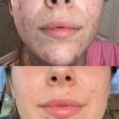 Clear Skin Combo – Acne Serum + Facewash (7 Days Acne Removal Guaranteed)