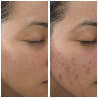 Clear Skin Combo – Acne Serum + Facewash (7 Days Acne Removal Guaranteed)