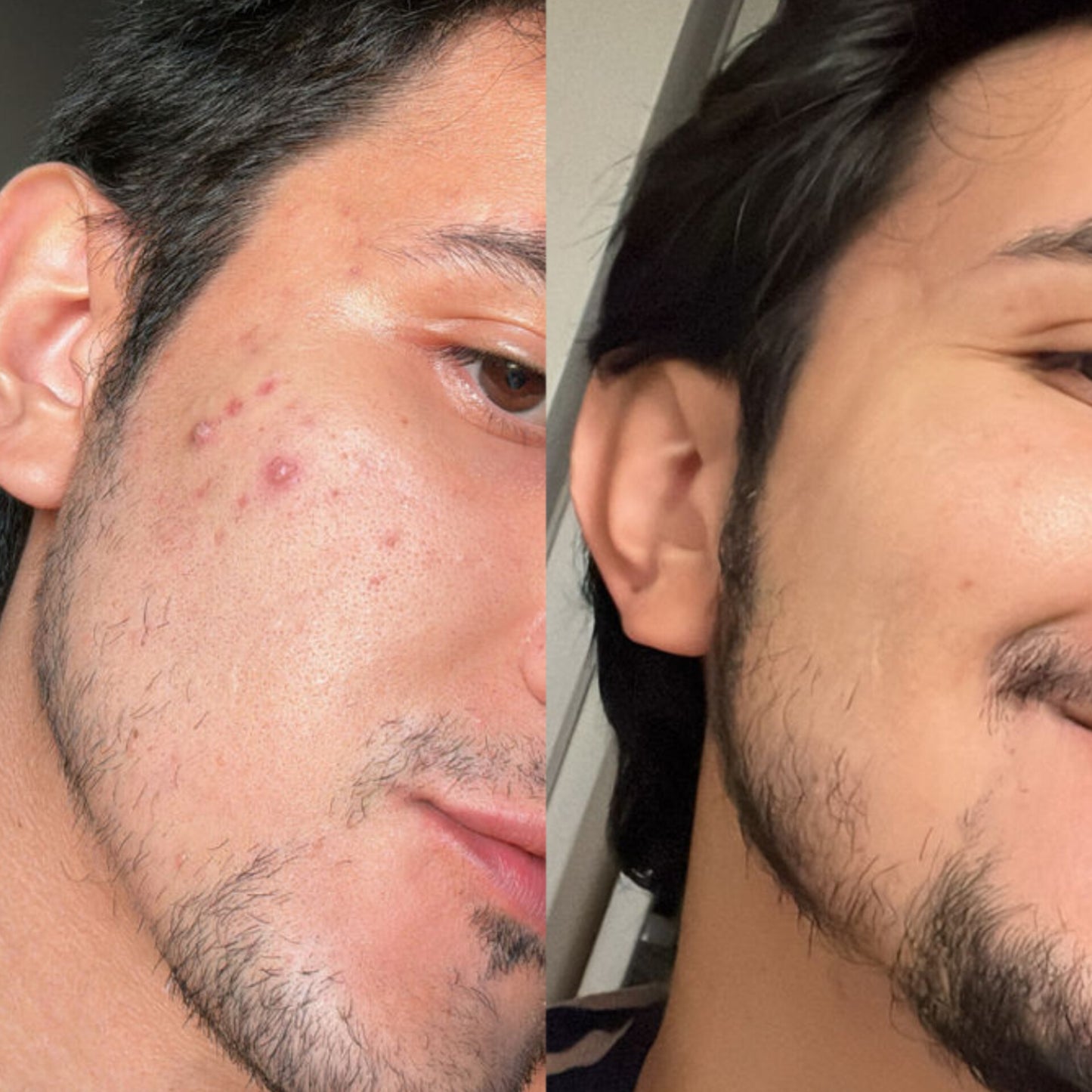 Clear Gel Face Wash with 2% Salicylic Acid + Glycolic Acid (For Acne-Prone Skin)